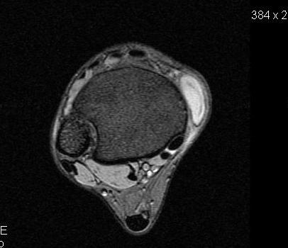 Ankle ganglion MRI